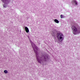 FIber-like clumps of tau called tangles, seen above, are abundantly found in the brain of someone with Alzheimer’s disease